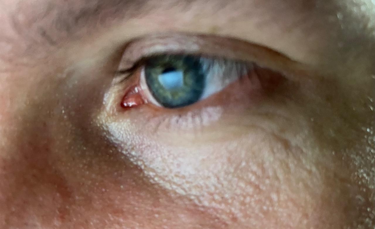 Dia Mundial do Glaucoma: Prevenção é a Chave para Evitar a Cegueira